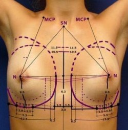 Jak prawidłowo dobrać implanty piersi?