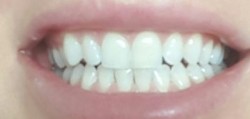 wybielanie zębów; wrażliwość; białe zęby; stomatologia; dentysta; zęby;