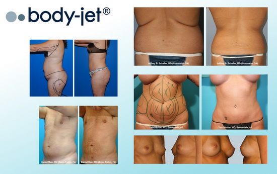 Body Jet