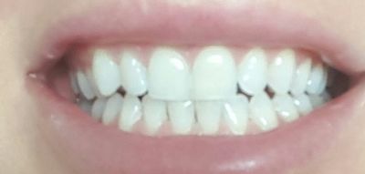 wybielanie zębów; wrażliwość; białe zęby; stomatologia; dentysta; zęby; wybielanie zębów; wrażliwość; białe zęby; stomatologia; dentysta; zęby;